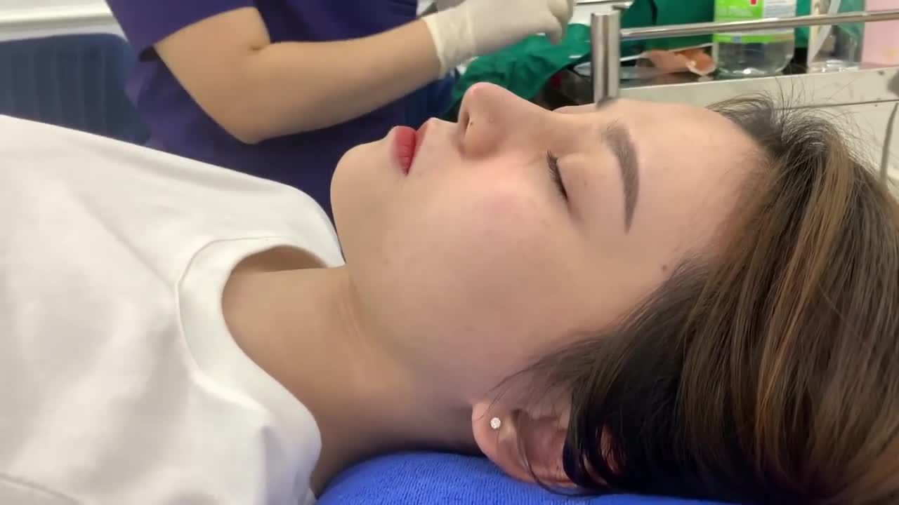 Case mũi bán cấu trúc tái khám cắt chỉ sau 10 ngày
