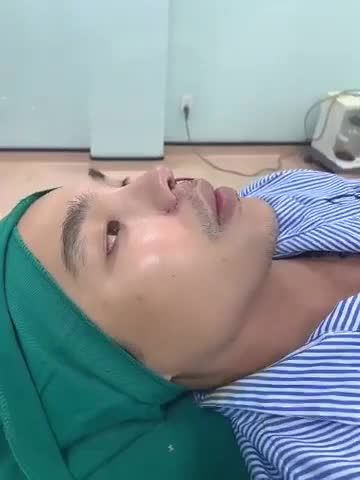 Case mũi cấu trúc sửa lại + chỉnh chân cánh mũi cho bạn nam tới từ Cần Thơ.