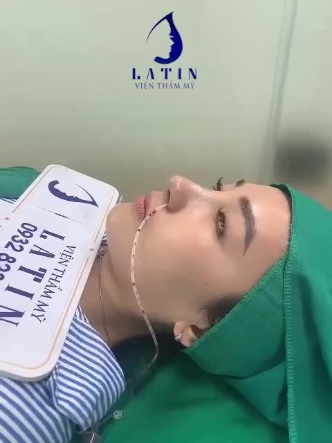 Case mũi sửa lại lần 2 cho em gái từng nâng mũi ở nơi khác nhưng không thành công