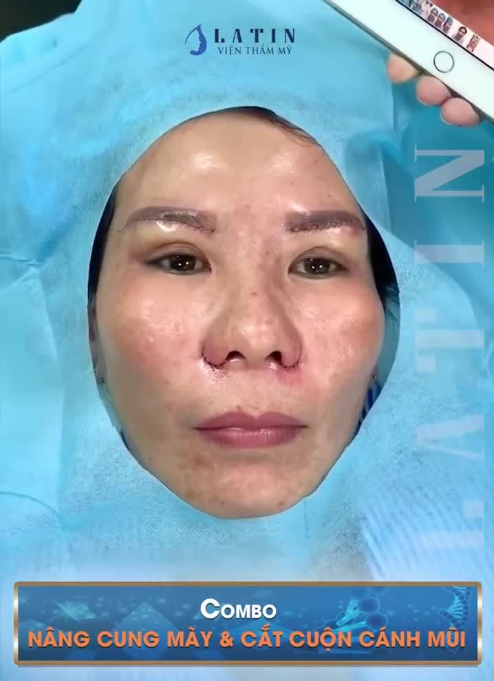Case nâng cung mày và cắt cuộn cánh mũi vừa hoàn thành, lấy lại tuổi thanh xuân cho chị Khách hàng.