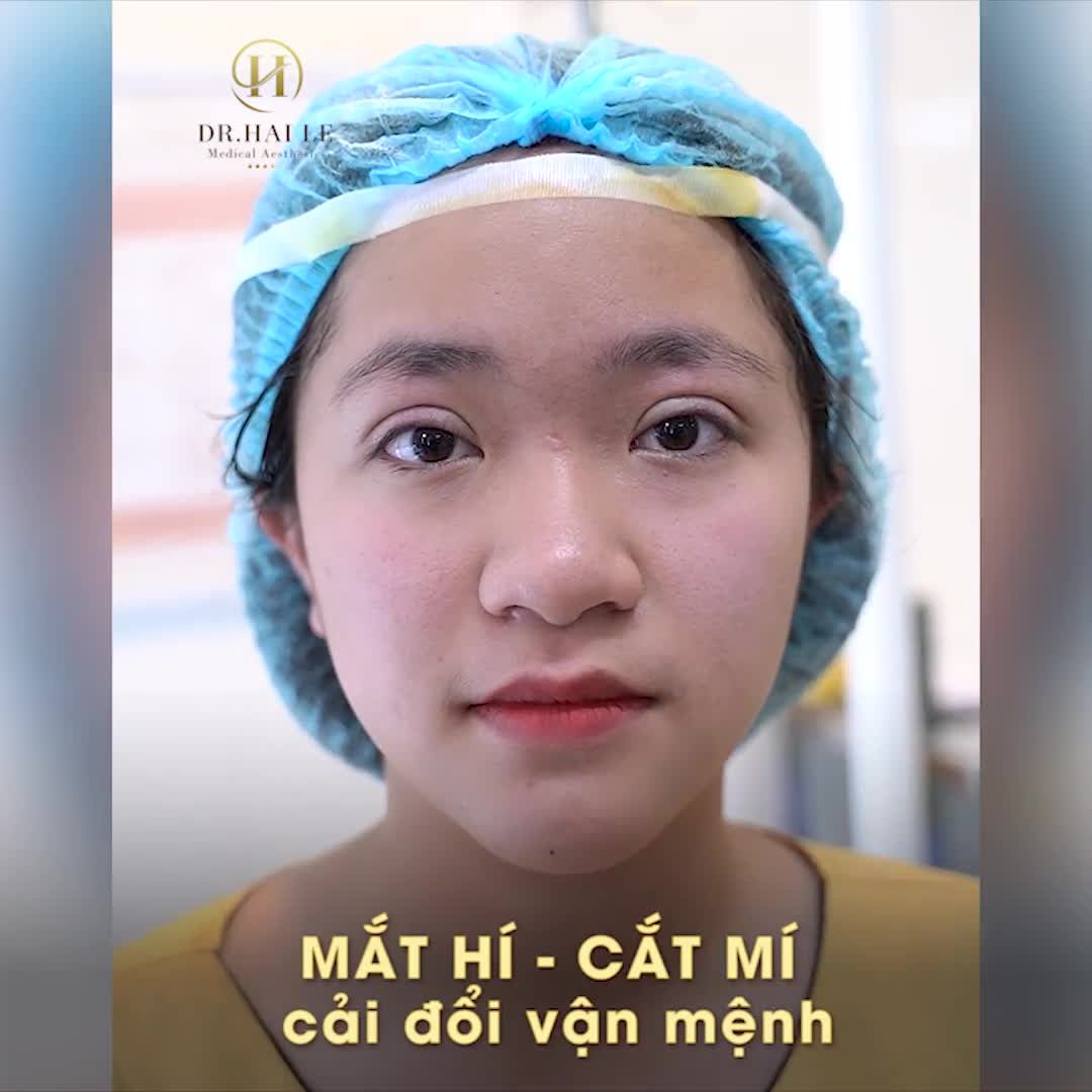CẮT MÍ - Mắt “ti hí” hóa mắt “long lanh” MÍ XẤU, MÍ NHỎ ... CHẲNG PHẢI LO...ĐẾN NGAY DR.HẢI LÊ