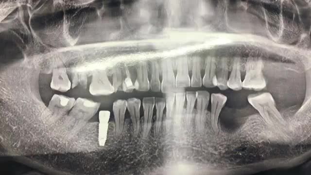 cấy implant phục hình răng 36 bị mất.