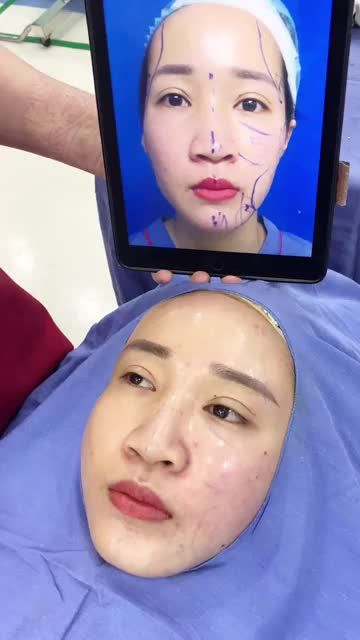 Cấy mỡ Nanofat- Làm đầy trẻ hóa