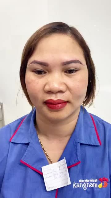 Chân mày chảy xệ Sụp mí, da dư Vết nhăn lão hóa xuất hiện