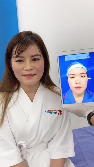 Chỉ 10 NGÀY - "Lột xác" sau NÂNG MŨI