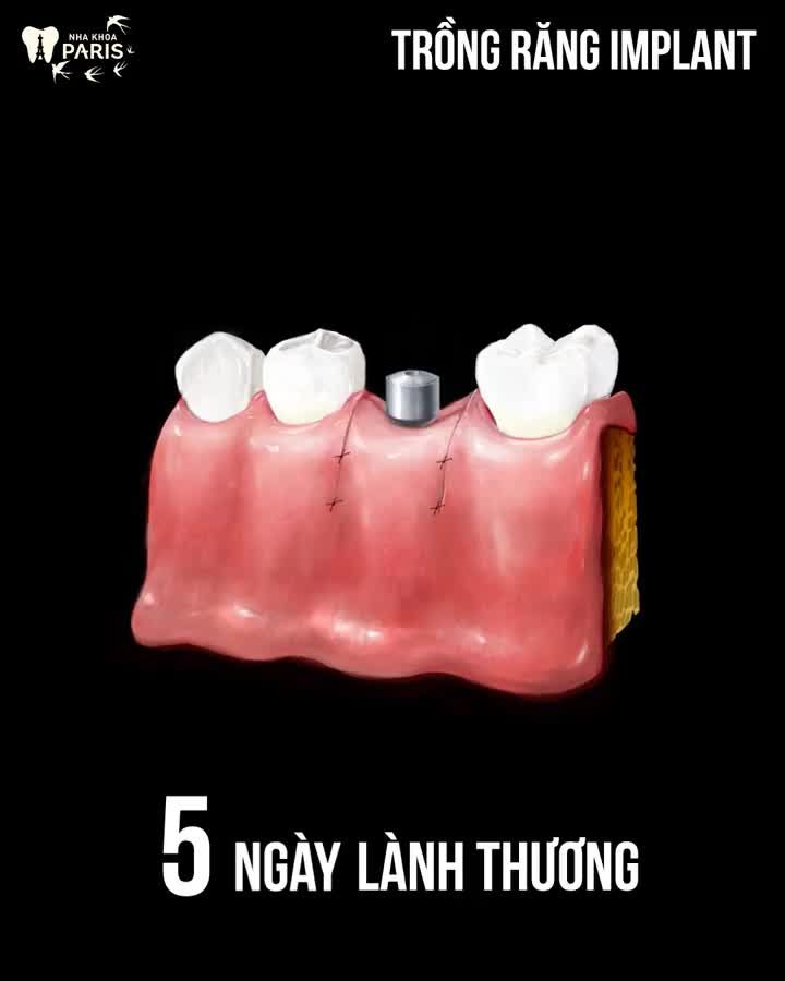 Chỉ 15 phút khôi phục răng mất - Bền chắc trọn đời