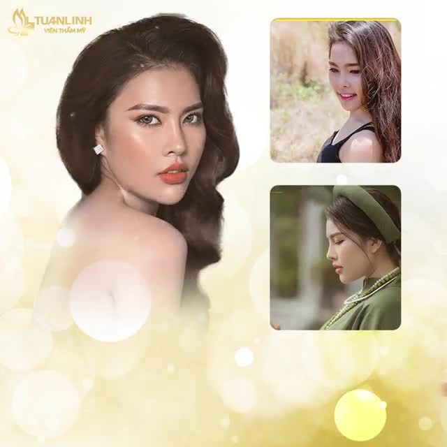 CHỈ 18 TRIỆU - NÂNG MŨI BÁN CẤU TRÚC - ĐẸP TỰ NHIÊN, HÀI HÒA ĐƯỜNG NÉT GƯƠNG MẶT.