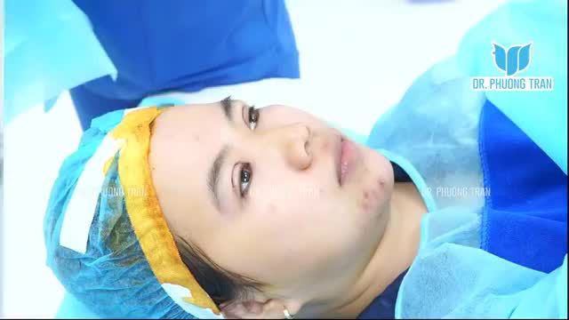 CHỈ 30 PHÚT, SỞ HỮU NGAY MỘT ĐÔI MẶT ĐẸP TỰ NHIÊN KHÔNG ĐAU, KHÔNG SƯNG BẦM. BẠN THÍCH KHÔNG?