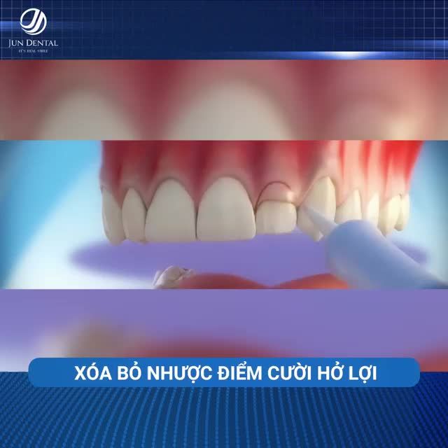 Xem thêm 1 video Điều Trị Cười Hở Lợi của bác sĩ Bs nha khoa Jun Dental