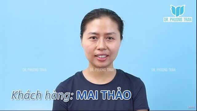 CHỈ NÂNG MŨI MÀ KHUYẾT ĐIỂM CƯỜI HỞ LỢI CŨNG ĐƯỢC KHẮC PHỤC. BẠN TIN KHÔNG?