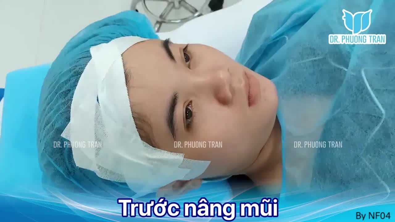 Chỉ nâng mũi thôi mà thay đổi cả nét mặt. Bạn tin không?