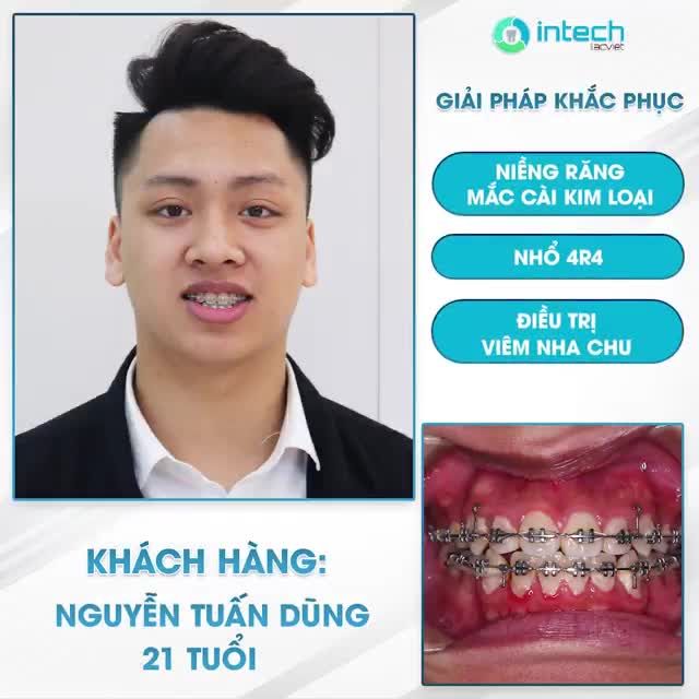 CHIA SẺ CỦA KHÁCH HÀNG NIỀNG RĂNG THƯA TẠI LẠC VIỆT INTECH