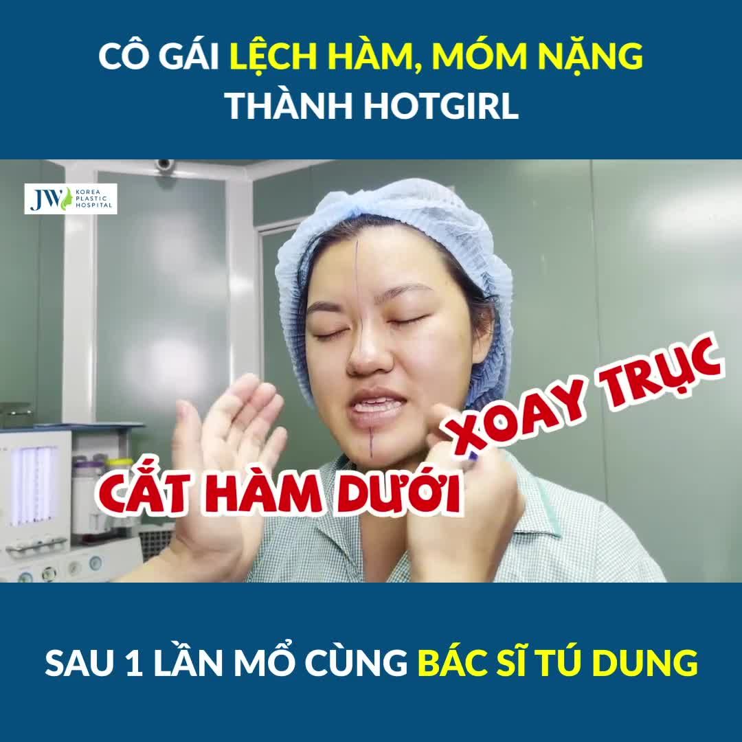 Cô gái LỆCH HÀM, MÓM NẶNG nhiều năm bỗng hóa HOTGIRL dưới bàn tay của Bác sĩ Tú Dung