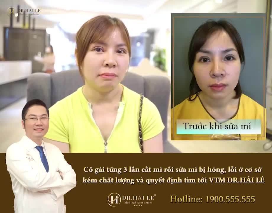 Cô gái từng 3 lần cắt mí rồi sửa mí bị lỗi, hỏng ở cơ sở kém uy tín và quyết định tìm tới Dr.Hải Lê để sửa lại.
