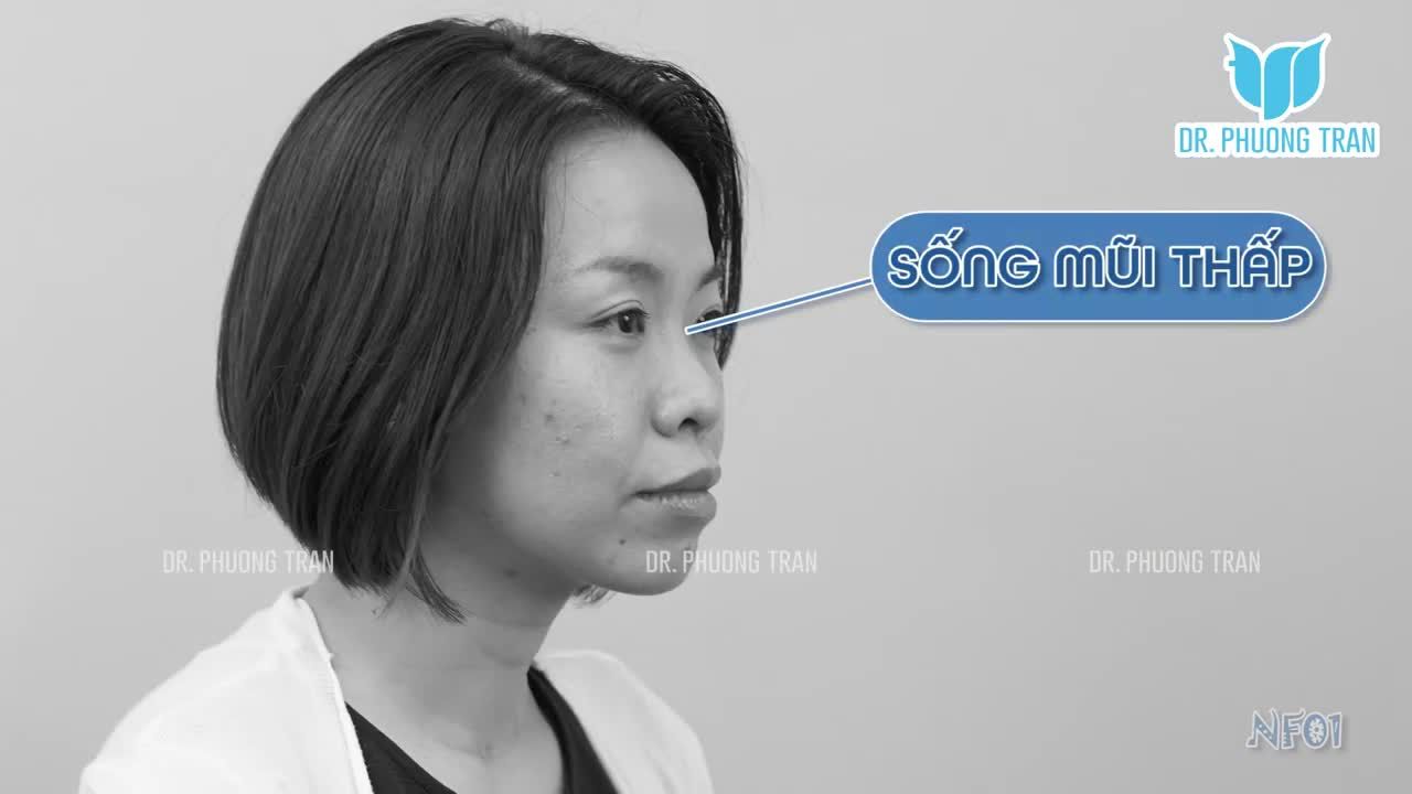 COMBO 2 MÓN NÂNG MŨI SỤN SƯỜN + CẤY MỠ CẰM ĐÃ GIÚP CÔ GÁI NÀY THAY ĐỔI THẾ NÀO?
