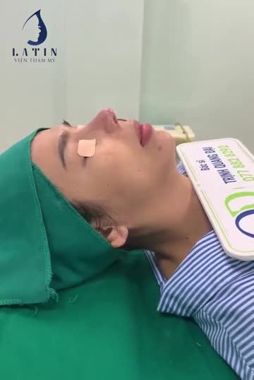 COMBO MŨI TÁI CẤU TRÚC SỬA LẠI LẦN 3 + ĐỘN CẰM US PROSIL