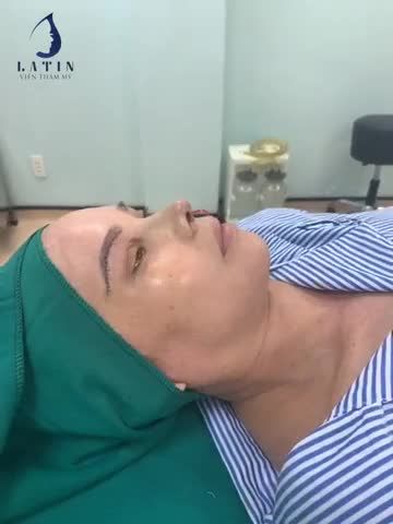 Combo Nâng cung mày đa tầng + Nâng mũi cấu trúc sửa lại lần 2 vừa có kết quả.