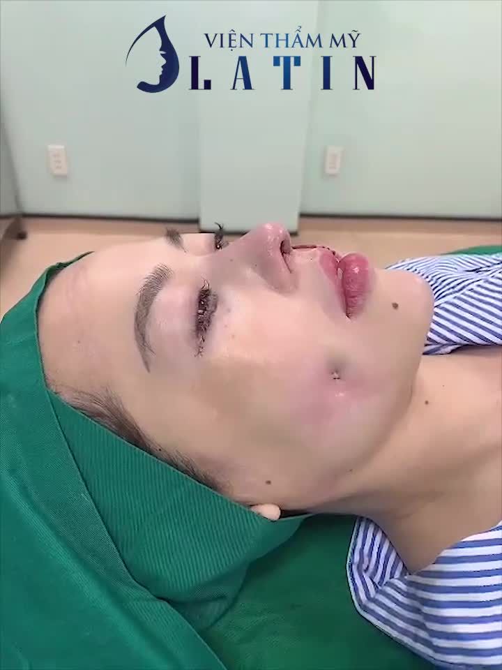 Combo nâng mũi cấu trúc sửa lại lần 4 + cắt mí dưới + tạo lúm đồng tiền vừa hoàn thành tại VTM Latin