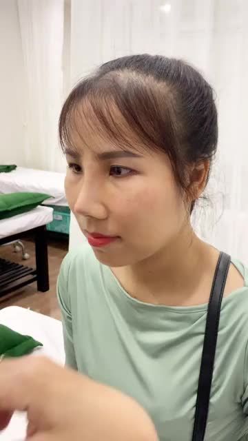 Cùng nghe và xem kết quả nâng mũi cấu trúc của khách hàng sau 8 ngày phẫu thuật