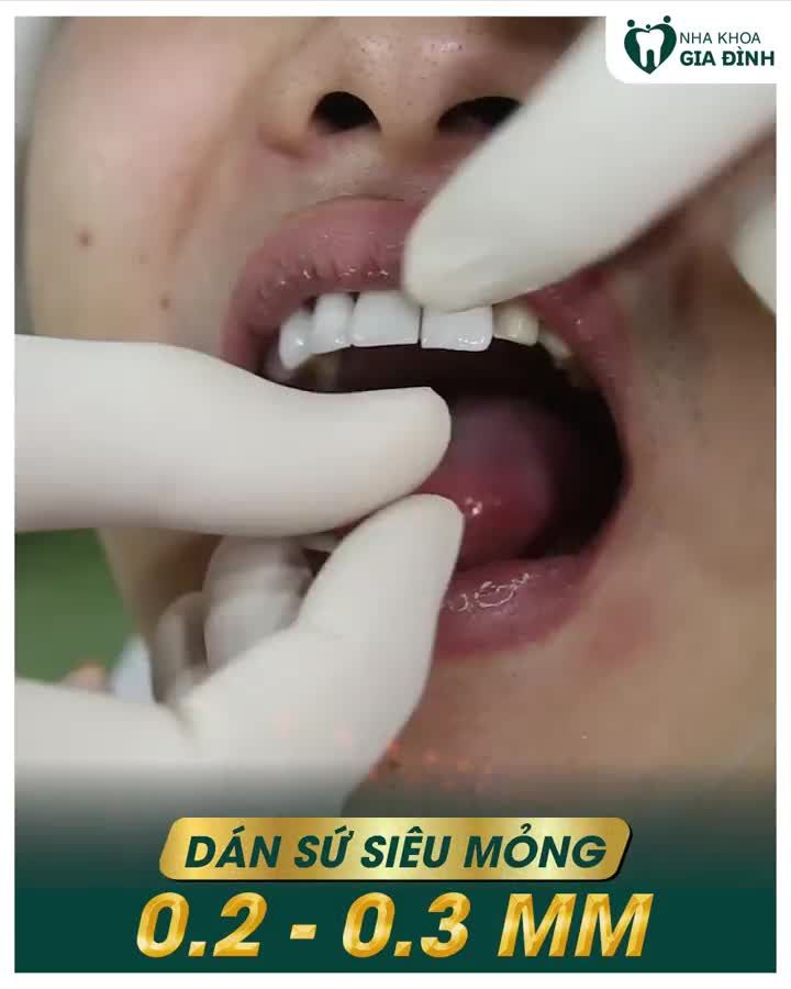 CƯỜI RẠNG NGỜI CHUẨN SAO VIỆT ƯU ĐÃI CỰC SỐC DỊCH VỤ THẨM MỸ RĂNG LÊN ĐẾN 70%