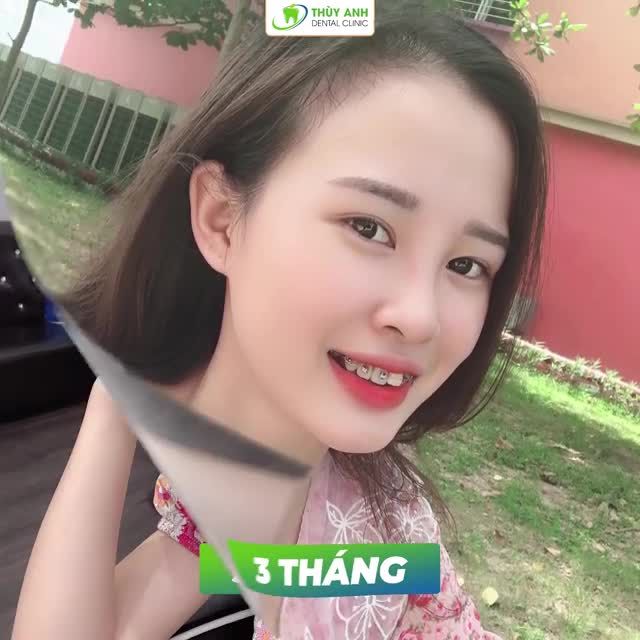 ĐÃ LÀ HOT GIRL NAY CÒN HOT HƠN NHỜ NIỀNG RĂNG