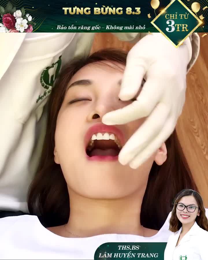 DÁN SỨ VENEER – BÍ QUYẾT CHO NỤ CƯỜI CHỊ EM RẠNG RỠ