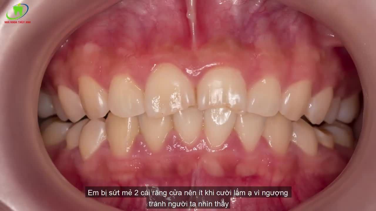 DÁN SỨ VENEER - THẨM MỸ RĂNG KHÔNG MÀI NHỎ RĂNG