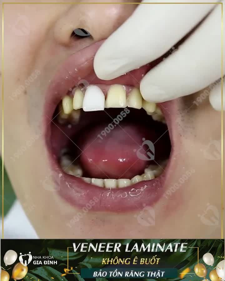DÁN SỨ VENER ƯU ĐÃI TỚI 50% - 20 SUẤT GIÁ TỐT CHO KH ĐĂNG KÝ SỚM NHẤT