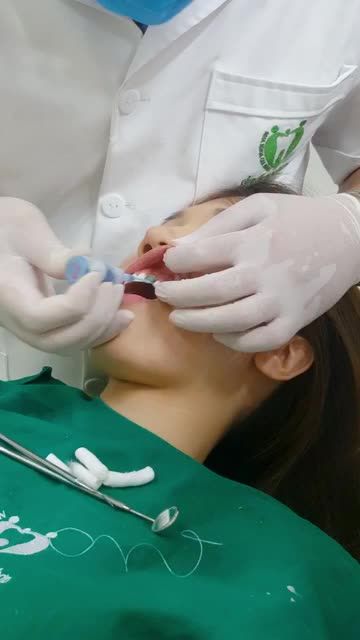 DÁN VENEER SỨ CHO MỘT VỊ KHÁCH HÀNG