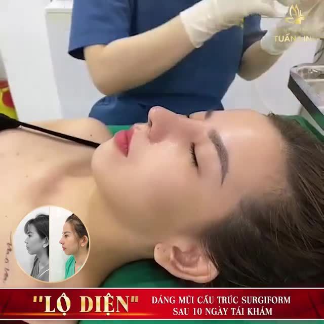 DÁNG MŨI CẤU TRÚC SURGIFORM SAU 10 NGÀY CÓ GÌ ĐẶC BIỆT? Sưng? Bầm? Nề? .... Hay vào phom dáng hoàn hảo rồi ???