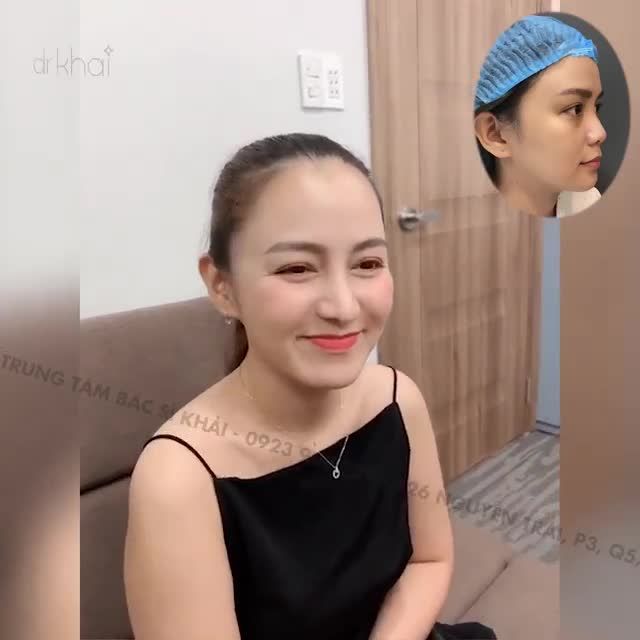 Dáng mũi cấu trúc surgiform tái khám sau 3 tháng.
