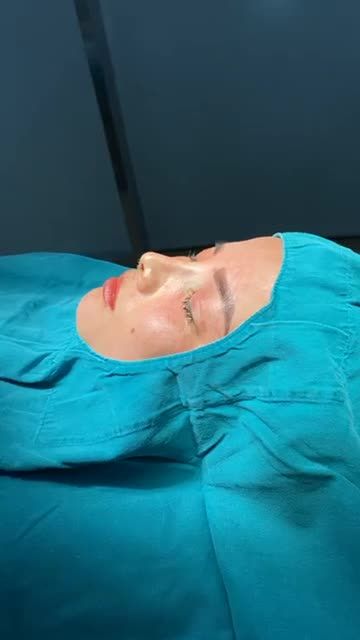 DÁNG MŨI TUYỆT PHẨM NHỜ PHƯƠNG PHÁP NÂNG MŨI CẤU TRÚC SOFTXIL