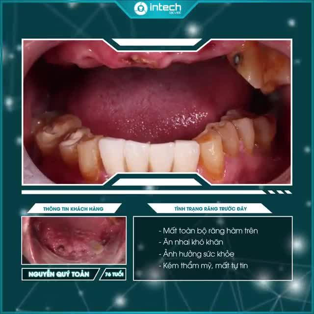 ĐẬP TAN NỖI LO KHÔNG THỂ ĂN NHAI BẰNG HÀM RĂNG TRỒNG IMPLANT HOÀN TOÀN MỚI