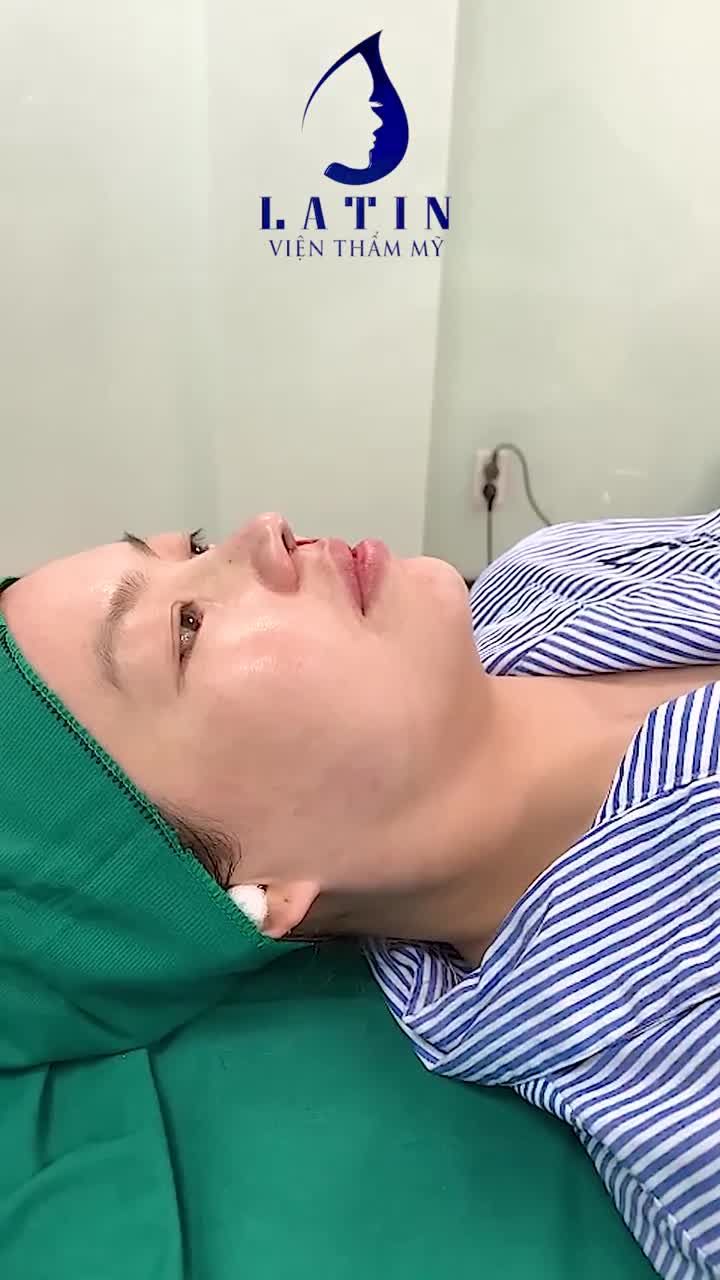 ĐẸP SANG BỘI PHẦN SAU NÂNG MŨI CẤU TRÚC
