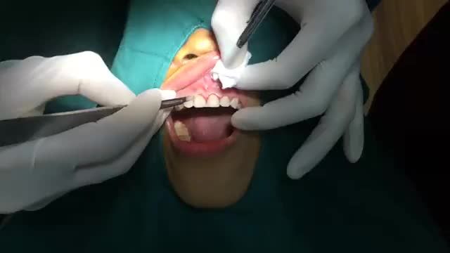 Điều trị cười hở lợi, lấy lại sự tự tin cho bạn nữ khách hàng tại nha khoa Thùy Anh.