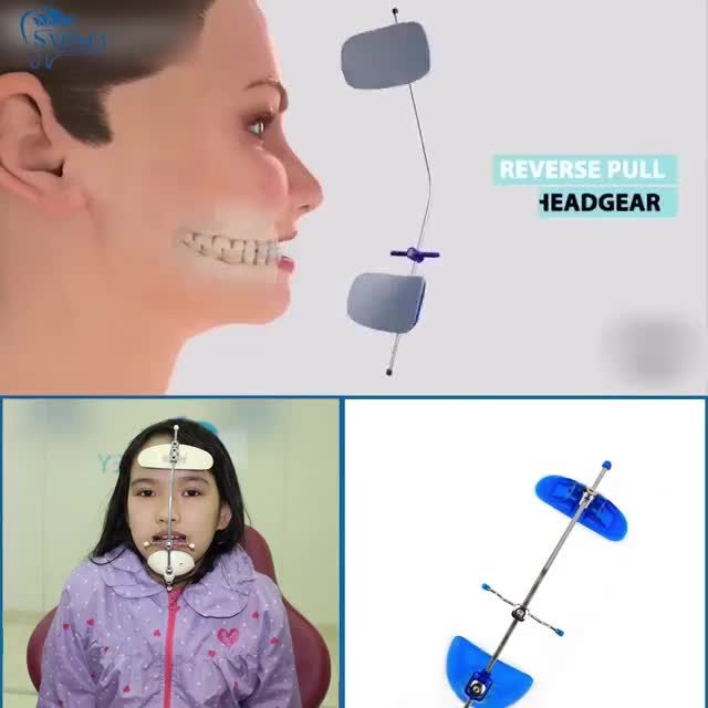 ĐIỀU TRỊ KHỚP CẮN NGƯỢC HIỆU QUẢ CHO TRẺ VỚI HÀM FACEMASK