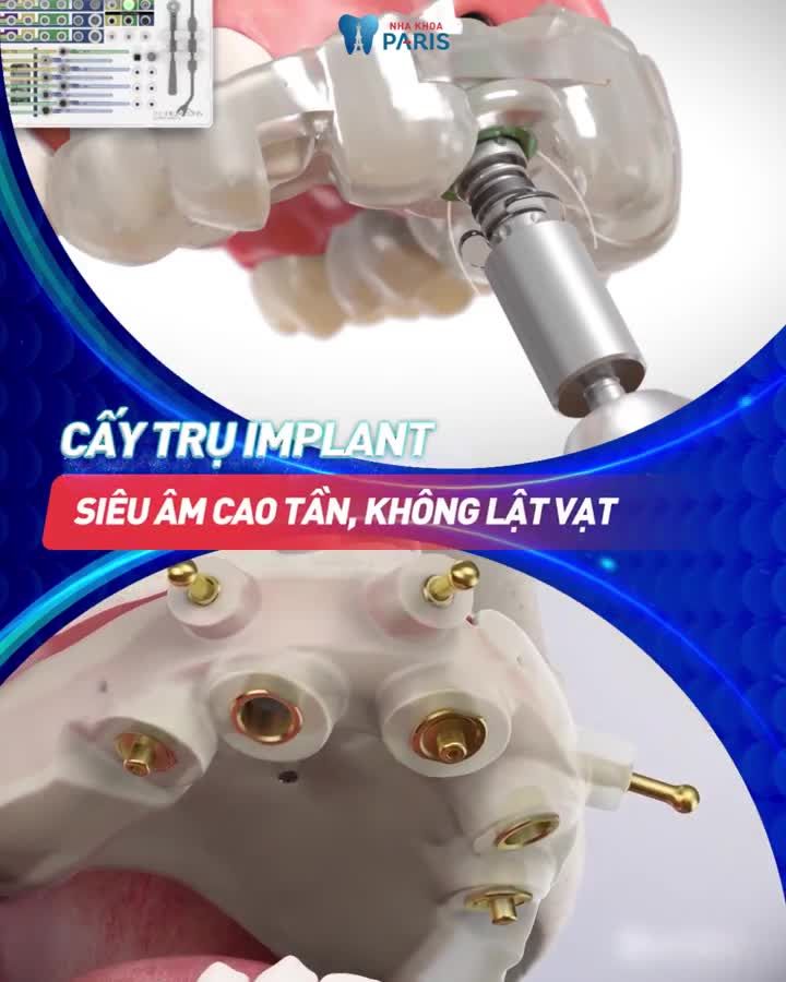 ĐỘC QUYỀN CÔNG NGHỆ TRỒNG RĂNG MINI 4S