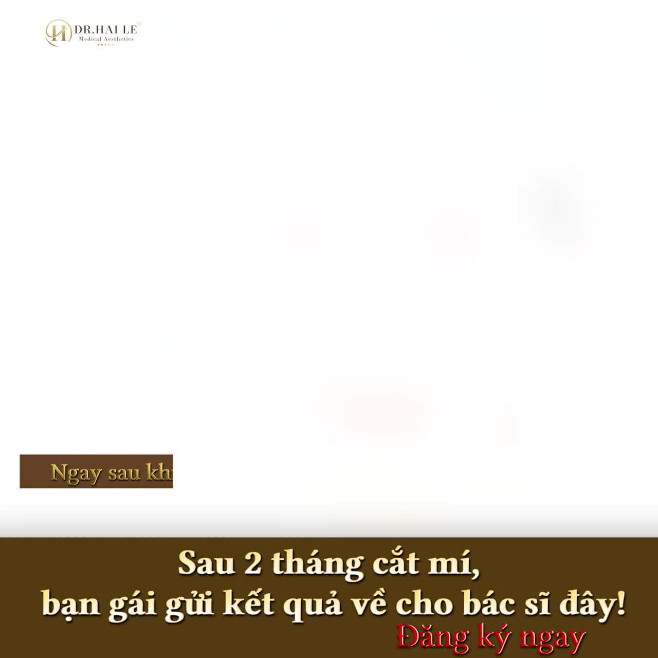 Đôi mắt 2 mí tròn đều, tự nhiên với hàng mi xinh xinh - kết quả “đẹp xuất sắc ” sau cắt mí 2 tháng của Dr.Hải Lê đấy ạ!