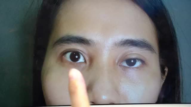 DR.HẢI LÊ GIẢI CỨU CA MÍ NHƯỢC CƠ NÂNG MI BẨM SINH GÂY SỤP MÍ + ĐÃ THỰC HIỆN CẮT MÍ NHƯNG KHÔNG THÀNH CÔNG!