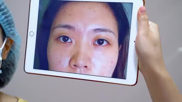 Dưới 30 tuổi mắt không rõ nếp mí, lão hóa sớm gây sụp mí già nua khắc phục bằng phương pháp nào? Theo dõi tiểu phẫu Cắt mí sau đây để có câu trả lời bạn nhé
