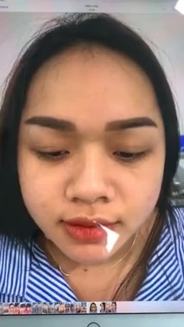Ekip nhà Latin vừa hoàn thành xong ca nâng mũi bọc sụn + thu nhỏ đầu mũi cho em gái vô cùng dễ thương. Dáng mũi thay đổi 180 độ sau ca phẫu thuật.
