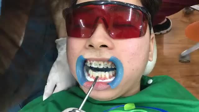 Gắn mắc cài cho bạn Đức điều trị tình trạng răng khấp khểnh, khớp cắn đối đầu