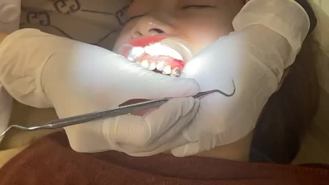 Gắn mắc cài cho bệnh nhân răng Khấp khểnh