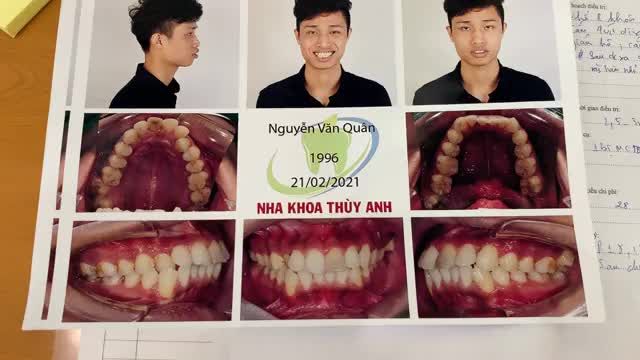 Gắn mắc cài điều trị răng hô cho bạn Quân.