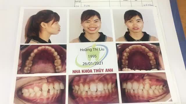 Gắn mắc cài điều trị răng hô, khép khe thưa cho bạn Lìu