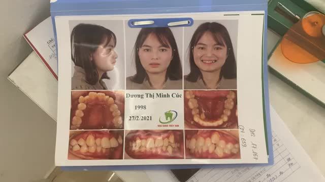 Gắn mắc cài điều trị răng lệch lạc, khấp khểnh cho bạn Minh Cúc.