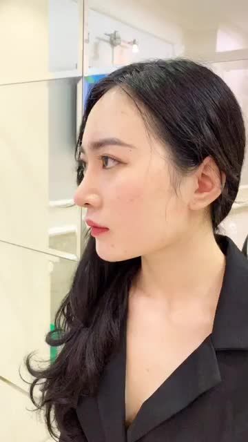 GẶP LẠI KHÁCH "RUỘT" NHÀ MEDIKA SAU 3 THÁNG NÂNG MŨI CẤU TRÚC