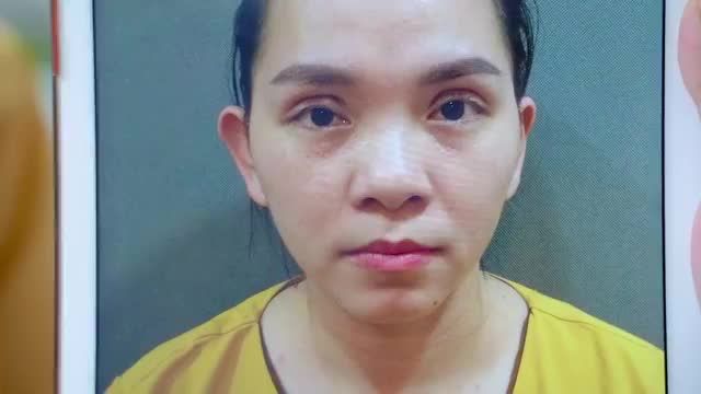 GIẢI CỨU KỊP THỜI CA MÍ LỖI HỎNG TẠI CƠ SỞ THẨM MỸ KHÔNG UY TÍN TRONG THỜI ĐIỂM VÀNG 12 NGÀY BẰNG KỸ THUẬT SỬA MÍ DEEPTECH