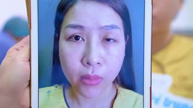 GIẢI CỨU THÀNH CÔNG CA MÍ BIẾN CHỨNG LỖI HỎNG ĐỨT CƠ NÂNG MI GÂY LIỆT CƠ SAU 3 LẦN PHẪU THUẬT TẠI CƠ SỞ KHÔNG UY TÍN