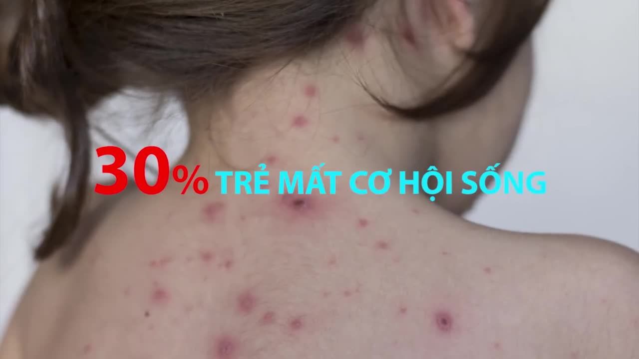 “GIỚI THIỆU VẮC XIN MỚI PHÒNG BỆNH THỦY ĐẬU - BÍ QUYẾT PHÒNG BỆNH MÙA ĐÔNG XUÂN CHO TRẺ EM VÀ NGƯỜI LỚN”